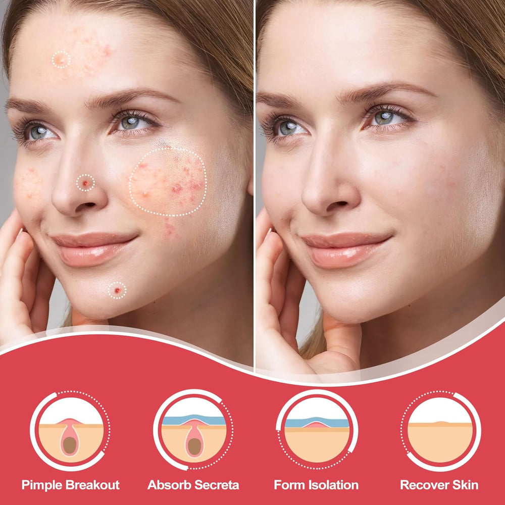 216 Counts Pimple Patches for Face, Hydrocolloid Acne Patches Zit Patches for Face Overnight Care Acne Spot Treatment Patch Cystic Acne Treatment Stickers Blemish Hydrocolloid Cover for All Skin Type